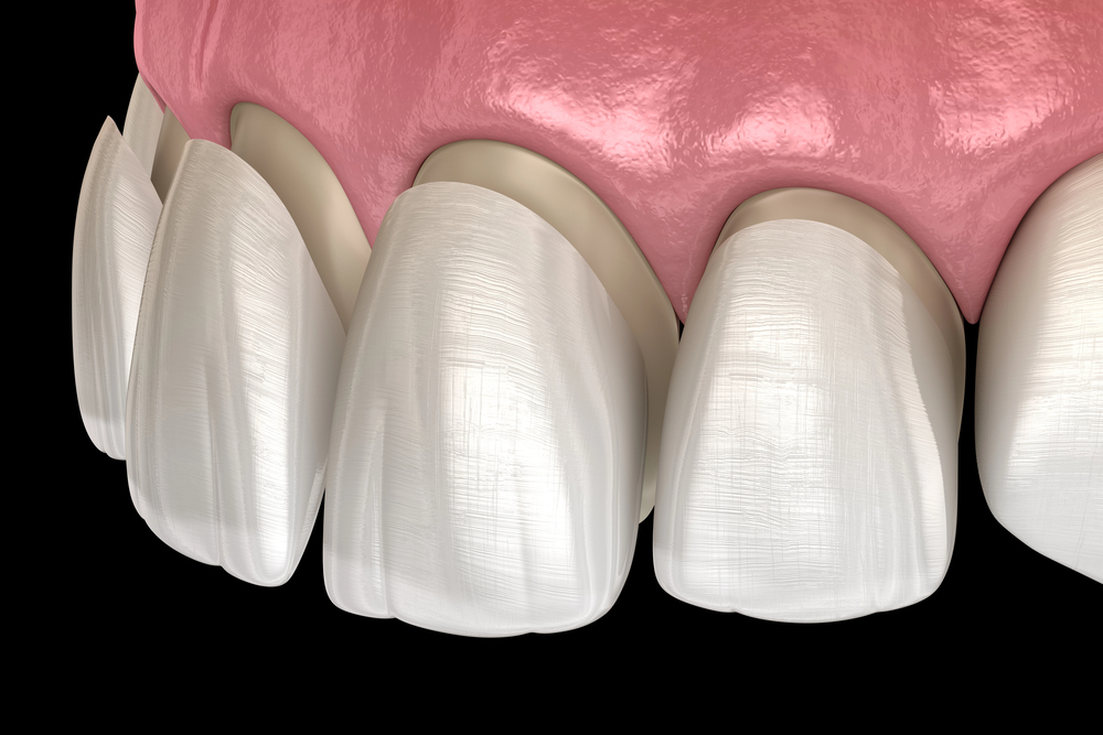 composite-vs-porcelain-veneers