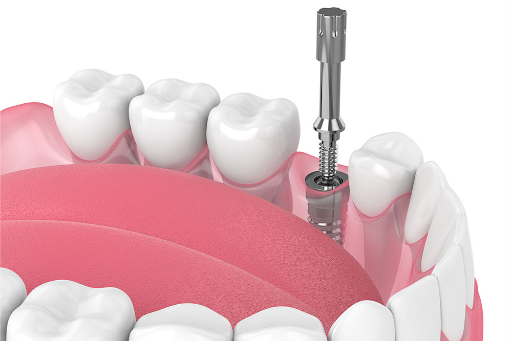 dental-implant-screw-types-explained