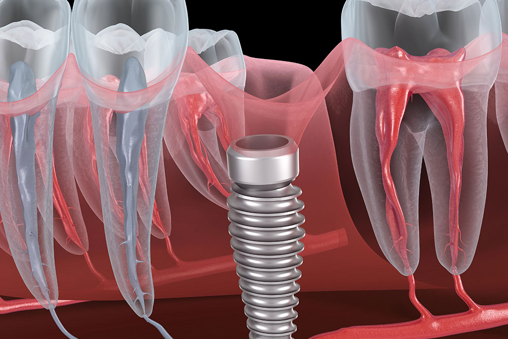 how-to-adjust-emergence-profiles-in-implant-procedures