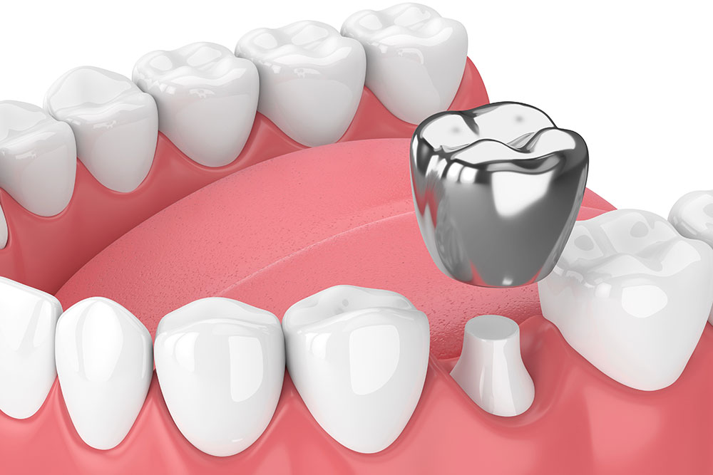 5-types-of-porcelain-crowns-for-your-patients