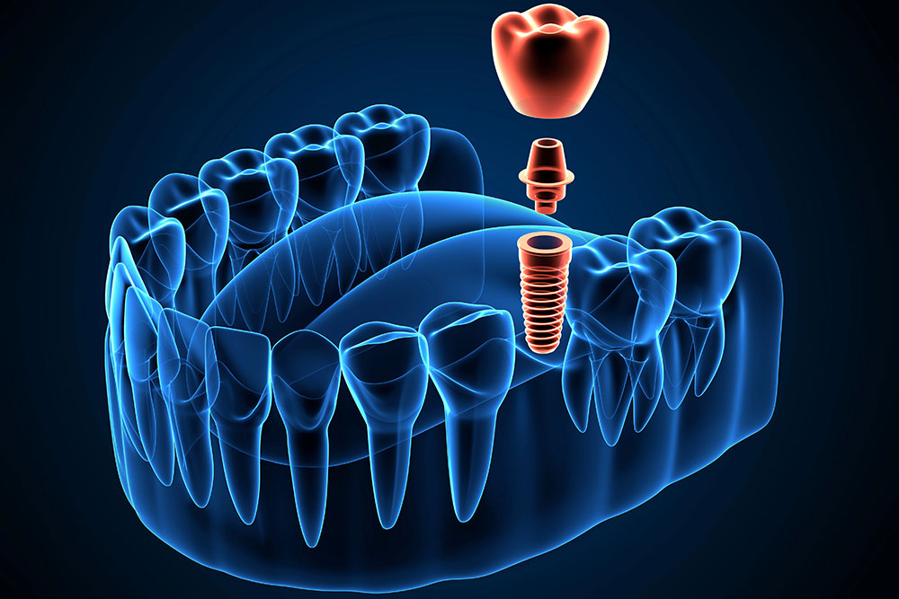 digital-dentistry-and-dental-implants-trends-transforming-the-industry