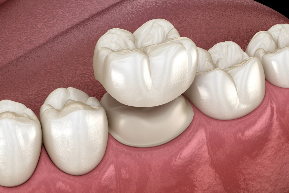 the-latest-innovations-in-dental-crown-technology