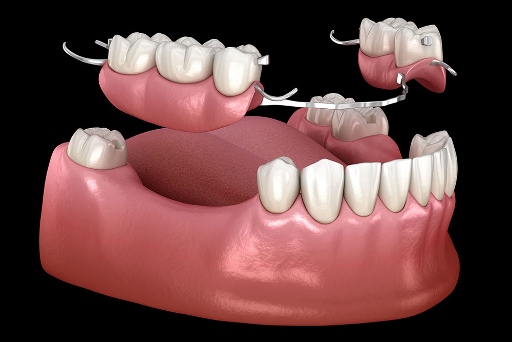 how-to-tell-if-partial-dentures-without-metal-clasps-are-right-for-your-patients