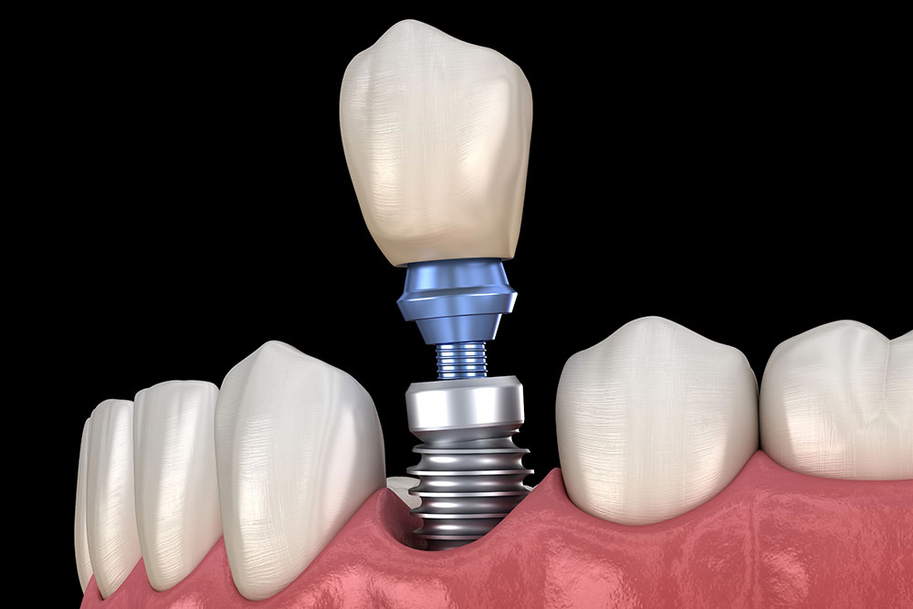 acrylic-vs-zirconia-dental-implants-which-material-is-best-for-your-patients