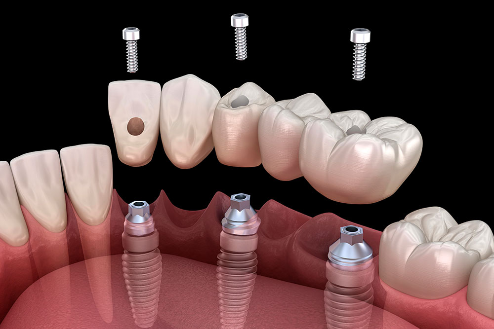 6-dental-implant-tools-every-dentist-should-have