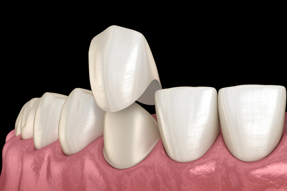 Dental Bonding Vs. Dental Crown: Which Option Fits Your Patients Best?